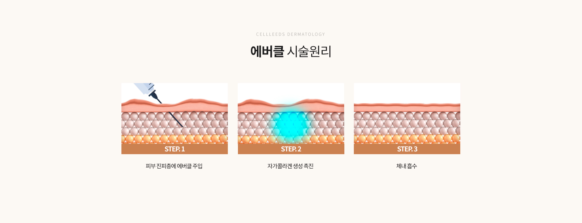에버클 시술원리