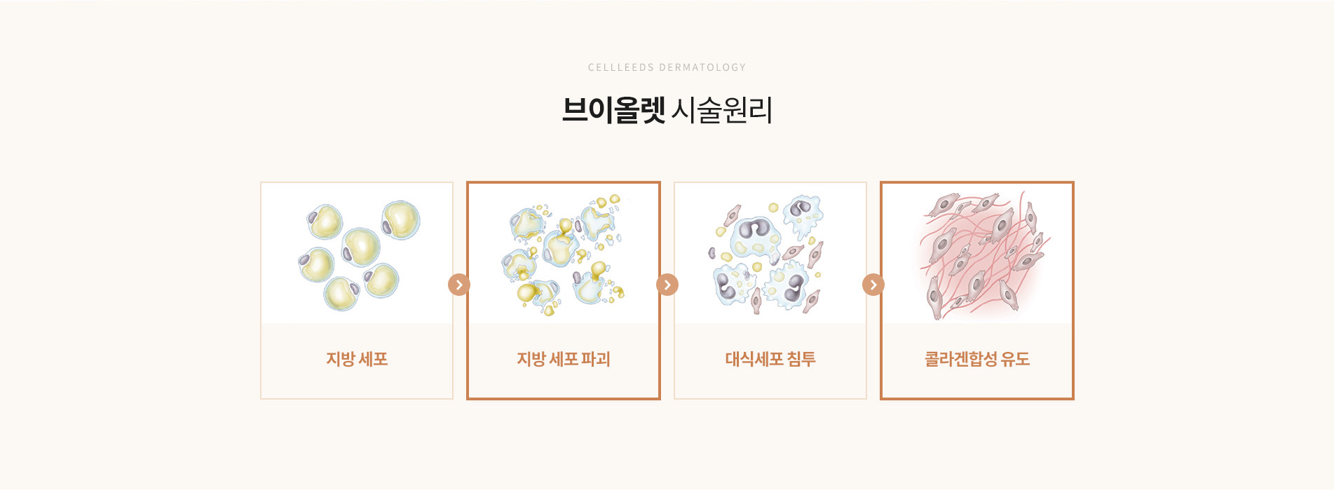 옴므브이올렛 시술원리