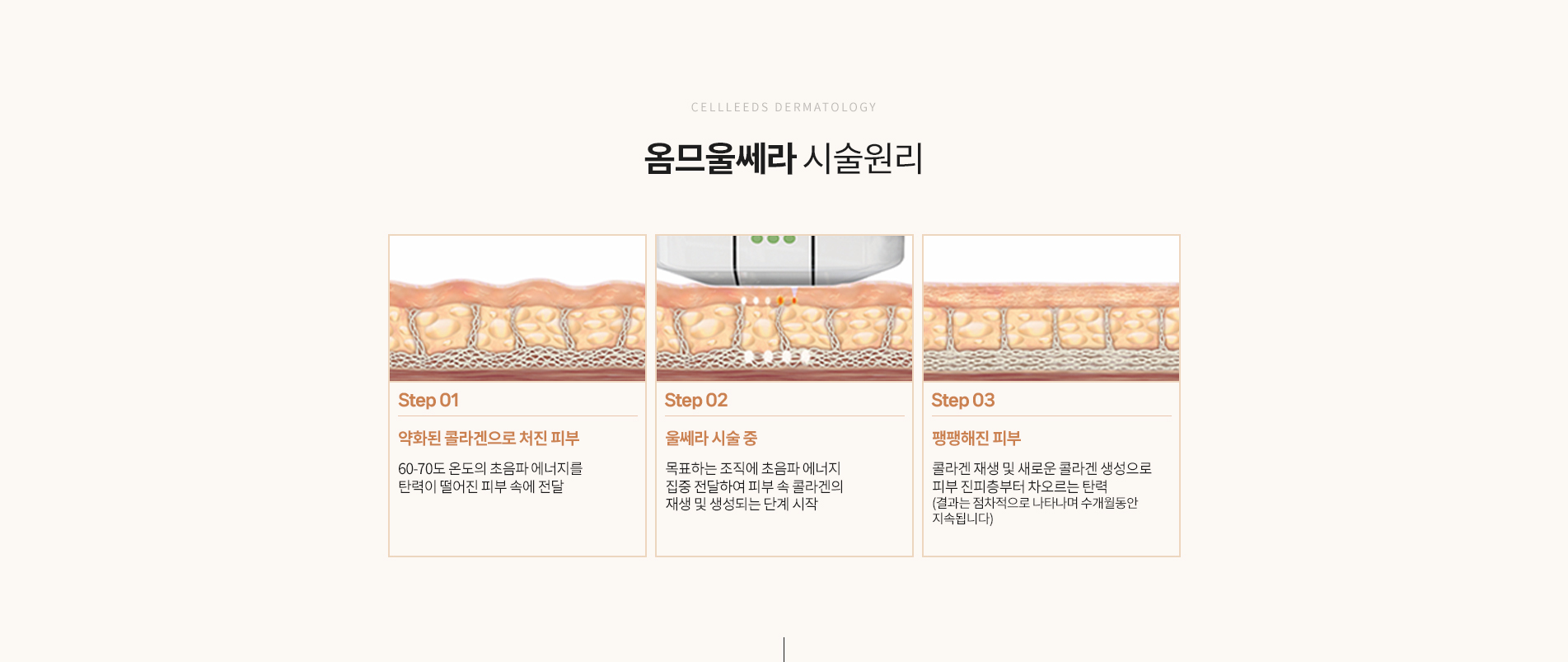 옴므울쎄라 시술원리