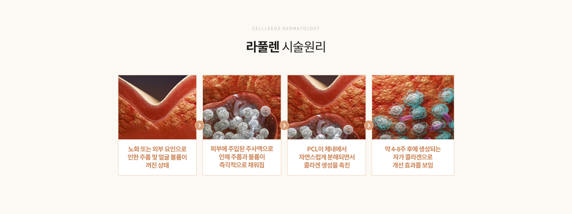 라풀렌 시술원리