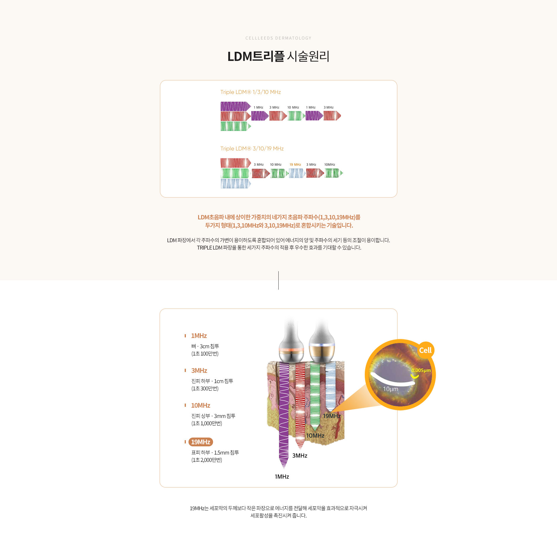 LDM트리플 시술원리