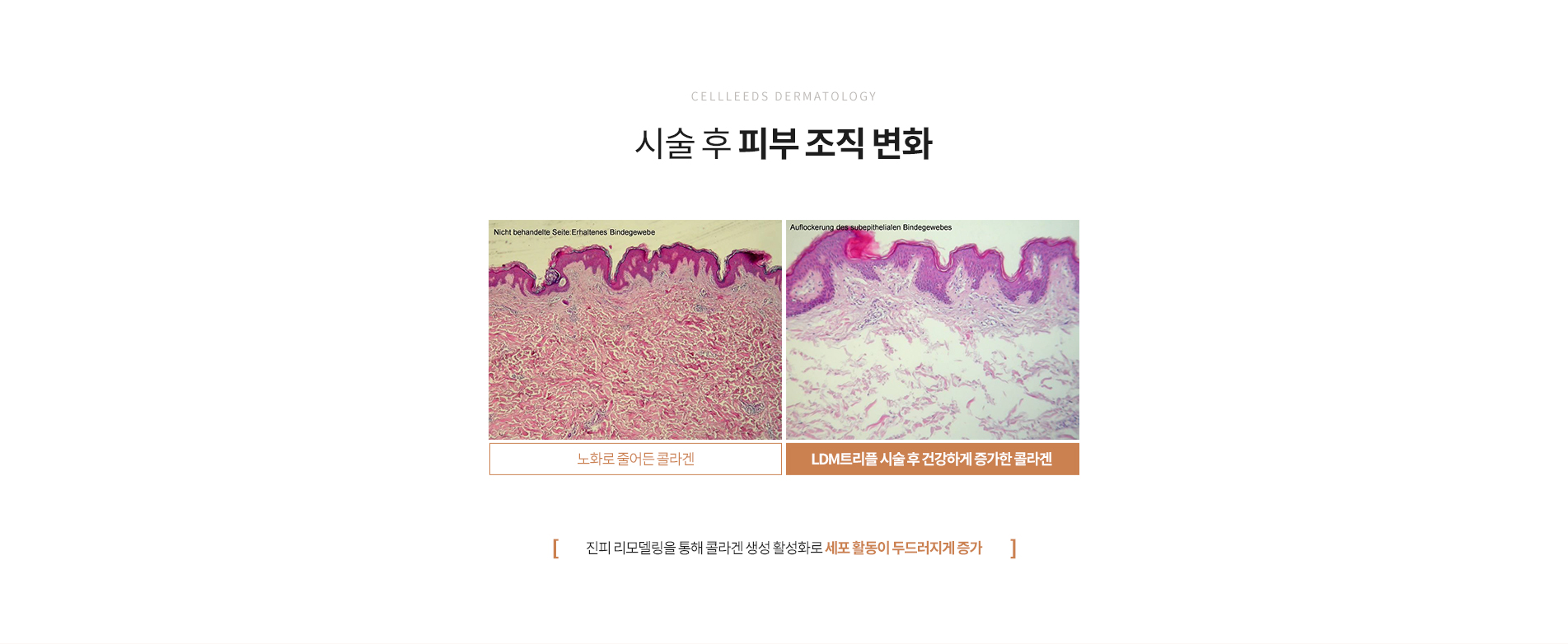 LDM트리플 피부조직 변화