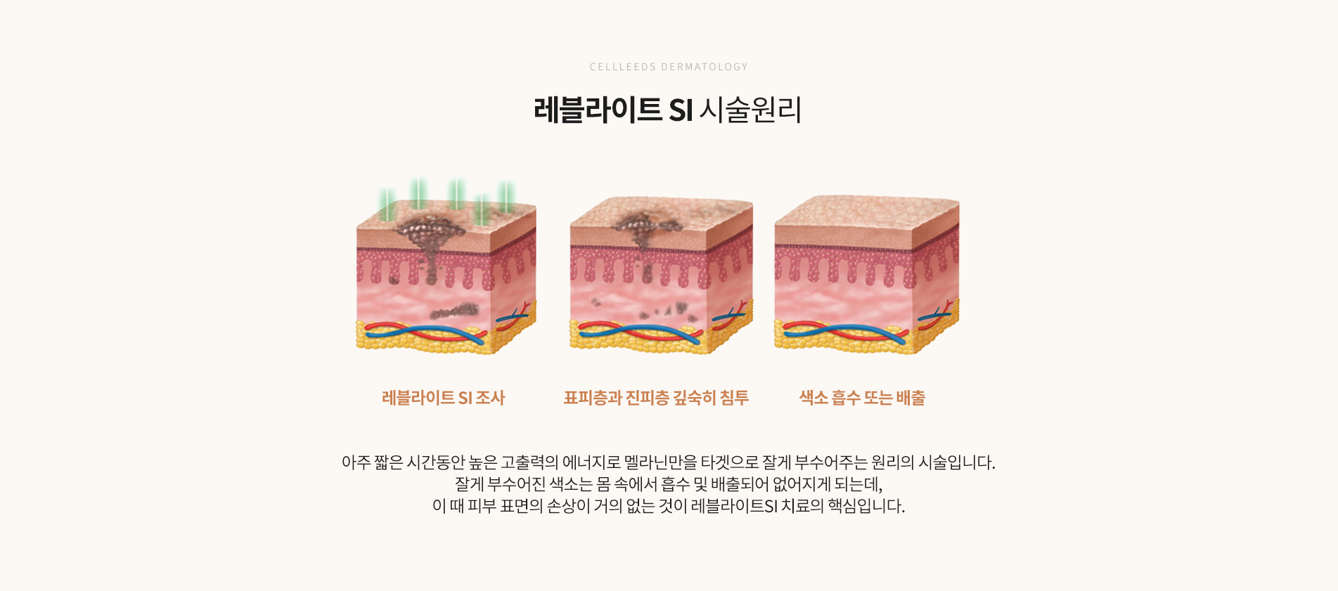 레블라이트 si 시술원리