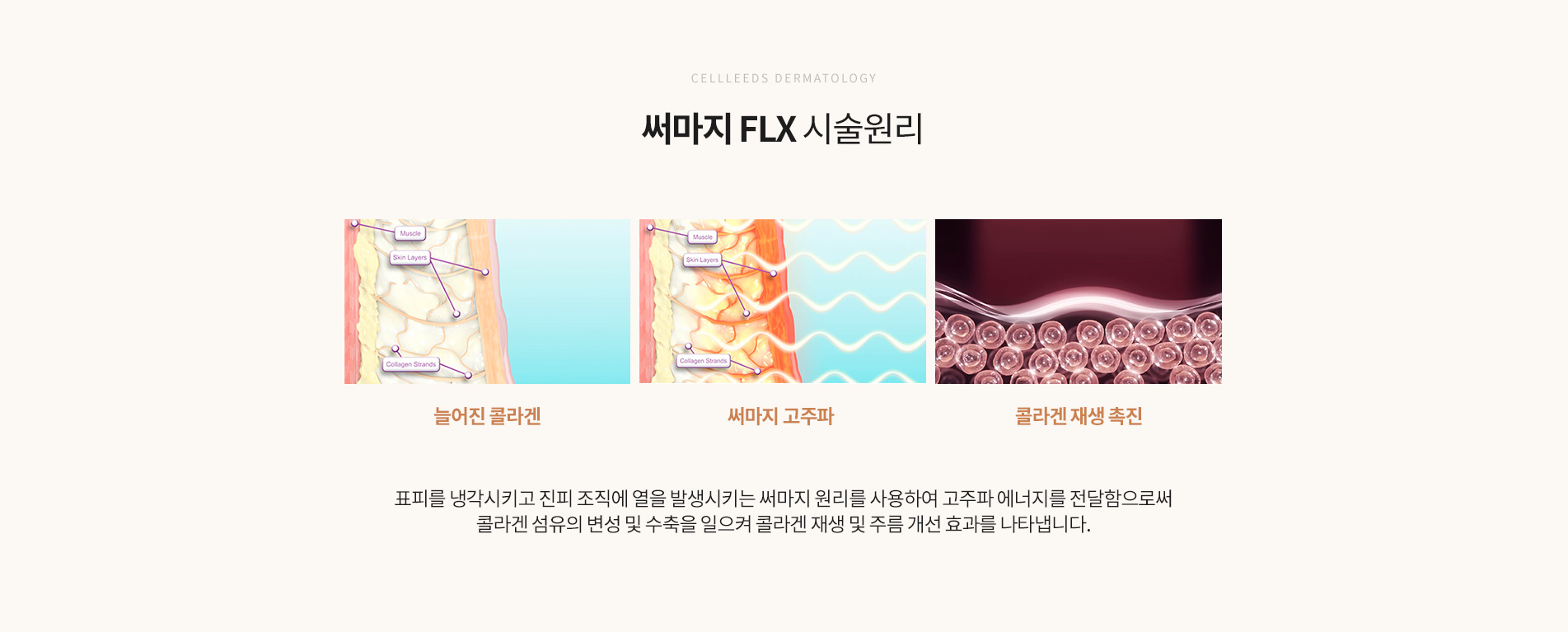 써마지 FLX 시술원리