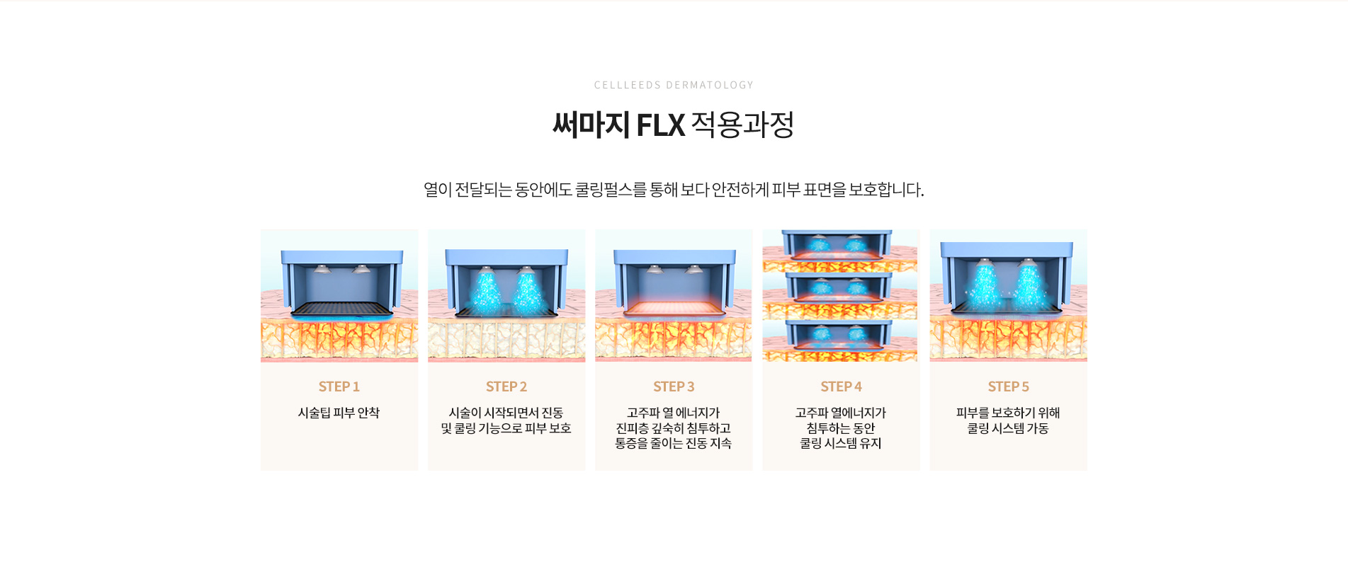 써마지 FLX 적용과정